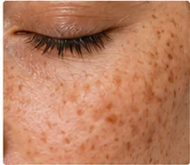 Primer plano de piel facial con manchas y pigmentación.