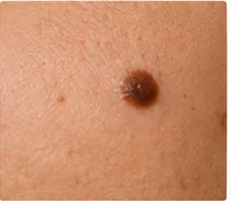 Primer plano de un lunar sobre la piel para sección de control dermatológico.