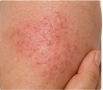 Primer plano de piel enrojecida para sección informativa sobre dermatitis.